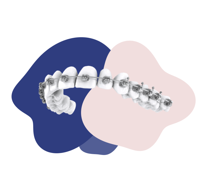 Braces Graphic